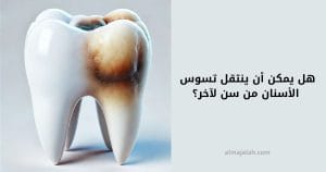 هل يمكن أن ينتقل تسوس الأسنان من سن لآخر؟ هل ينتقل التسوس بين الأسنان؟